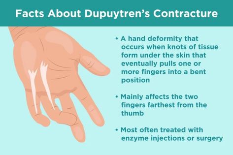 Dupuytren's Contracture, Carpal Tunnel Exercises, Hand Therapy Exercises, Hand Health, Hand Exercises, Hand Pain, Medical Terms, Hand Therapy, Two Fingers