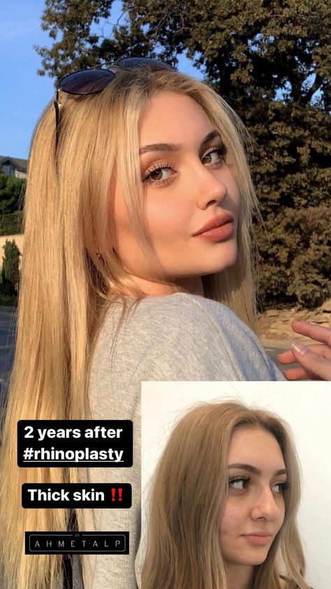 Thick skin = @dr.ahmetalp Bulbous Nose Job Before And After, Thick Skin Bulbous Tip Rhinoplasty, Nose Job Thick Skin, Thick Skin Rhinoplasty, Wide Button Nose, Ideal Nose Rhinoplasty, Barbie Nose Rhinoplasty, Beautiful Nose Shape, Rhinoplasty Aesthetic