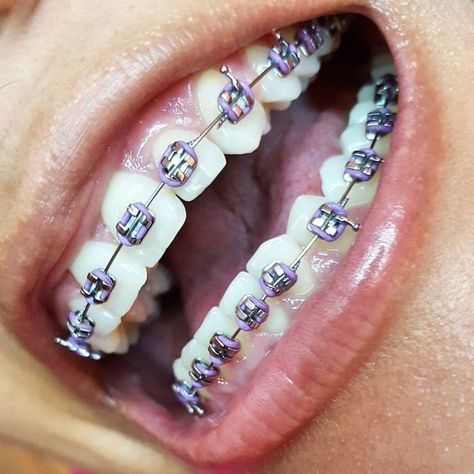 Braces Colours, Dental Braces Colors, Invisible Teeth Braces, Braces Ideas, Braces Cute, Braces Colors Ideas, Braces Smile, Braces Bands, Cute Braces Colors