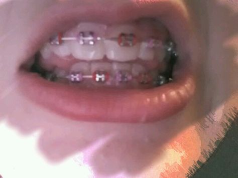 Pink And Orange Braces, Light Pink Braces Aesthetic, Pink And Red Braces, Dark Red Braces, Red Braces, Pink Braces, Green Braces, Dental Braces Colors, Teeth Aesthetic