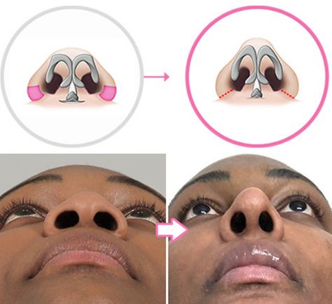 Round Nose Rhinoplasty, Wide Nose Rhinoplasty, Rhinoplasty Before After, Ethnic Nose Job, Nasal Tip Rhinoplasty, Rhinoplasty Recovery Tips, Tip Plasty Nose, Revision Rhinoplasty, Nose Plastic Surgery