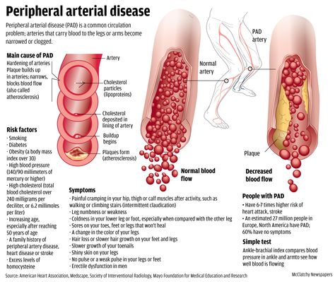 PAD is dangerous because these blockages can restrict circulation to the limbs and organs. Without adequate blood flow, the kidneys, legs, arms and feet suffer damage. Nursing Bag, Vascular Surgery, Nursing Schools, Cardiac Nursing, Nursing School Survival, Nursing School Studying, Medical Coding, Nursing Tips, Wound Care