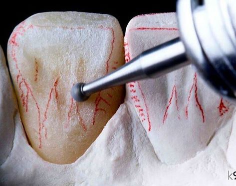 Dental Ceramics, Dental Wallpaper, Dental Photos, Dentist Art, Dental Images, Dental Restoration, Dental Aesthetics, Dental Videos, Dental Photography