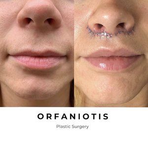 Lip Lift Before and After Gallery Lip Augmentation Before And After, Vyvanse Before And After, Lip Lift Before And After, Lip Flip Before And After, Lip Flip Fibroblast, Lip Plastic Surgery, Lip Lift Surgery, Lip Flip, Lip Lift