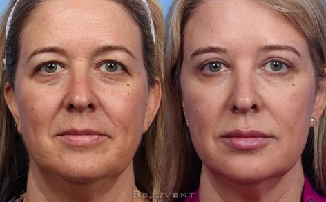 Upper Eyelid Surgery and Liquid Face Lift beautiful results Eye Hollows, What Is Fiction, Liquid Facelift, Cosmetic Fillers, Eyebrow Lift, Natural Face Lift, Facial Fillers, Injectables Fillers, Upper Eyelid