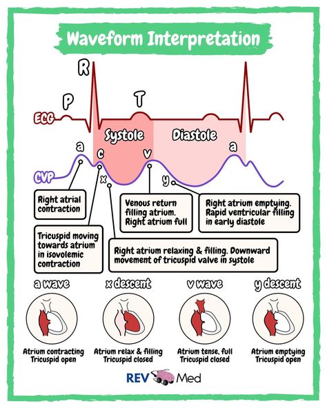 Here’s some Sunday CVP review ⤵️ Don’t you worry - this week we’ll hit some awesome topics but only on your favorite IG page 👉🏼@rev.med Central Venous Pressure (CVP) ✅ Overview CVP is the pressure measured in the central veins close to the heart. It indicates mean right atrial pressure and is frequently used as an estimate of the right ventricular preload. CVP reflects the amount of blood returning to the heart and the ability of the heart to pump the blood into the arterial system. ✅ M... Ventricular Tach, Cardiac Output Nursing, Cardiac Conduction System Nursing, Coronary Angiography, Cath Lab Nursing, V Fib Cardiac Rhythms, Pulmonary Artery Catheter, Nurse Skills, Nursing Classes