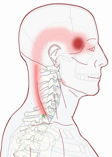 Self Care - Headache At Your Temple - Integrative Works Temple Headache Causes, Temple Headache, Headache Chart, Forward Head Posture Exercises, Sinus Congestion Relief, Neck And Shoulder Muscles, Yoga Information, Pain Relief Patches, Forward Head Posture