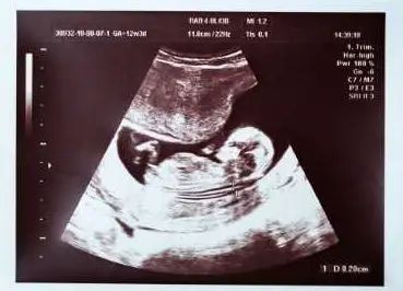 Boy Ultrasound Pictures, Baby Gender Ultrasound, Ultrasound Gender Prediction, Boy Ultrasound, Husband Pregnancy Reveal, Ultrasound Gender, Baby Ultrasound Pictures, 12 Weeks Pregnant, Pregnant With A Girl