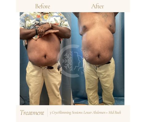 Check out these impressive results! After just 3 cryo slimming sessions, the transformation on the lower abdomen and middle back is clear. Hard work pays off! 💪❄️ #BeforeAndAfter #BodyTransformation” #CryoSculpting #results #before #beforeandafter #cryo #noninvasivetreatment #noninvasive #summerbody #toning #sculpting #trasformation #slimming #healthylifestyle #before #after #summerville #charleston #cryotherapy #bodypositive #bodytoning #results #skin #summer Cool Sculpting Before And After Stomach, Bodytite Procedure Before And After, Lower Abdomen, Hard Work Pays Off, Summer Body, Toned Body, Transformation Body, Body Positivity, Hard Work