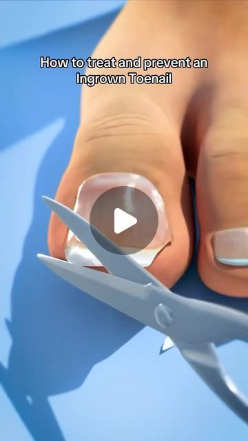 Dr Noman M | Ingrown toenail - prevention / management 
#drnomzzy #ingrowntoenail #toe | Instagram Ingrown Toenail Remedies, Toenail Removal, Ingrown Toenail, Ingrown Toe Nail, Combination Skin, Skin Tightening, Toe Nails, Skincare Routine, Skin Types