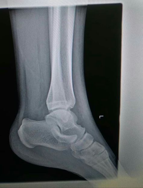 #The C sign is an important radiological sign which may be seen on a lateral radiograph of the ankle in those with the #talocalcaneal subtype of tarsal coalition Tarsal Coalition, X-ray Images, Ankle Surgery, Broken Ankle, Leg Bones, Hospital Photos, Songs Playlist, Sprained Ankle, Nursing Education