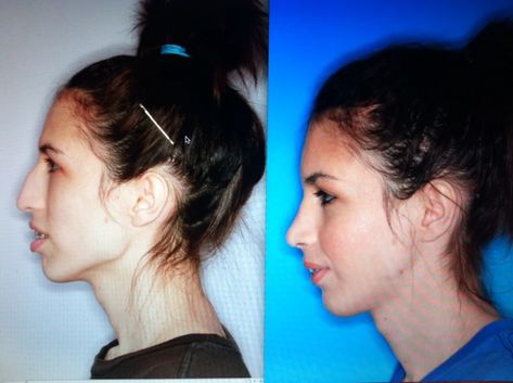 Before and After Pictures of Jaw Surgery, Oral Surgery Boca & Delray FL Boca Jaw Surgery Chin Reduction, Lipo Before And After, Cheek Implants, Jaw Surgery, Oral Surgeon, Florida City, After Pictures, Cosmetic Procedures, Pompano Beach