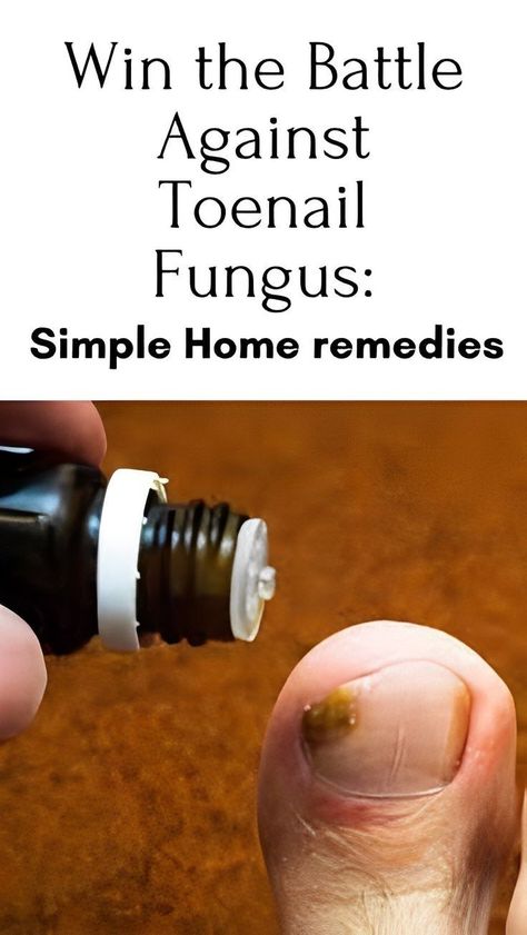 Simple home remedies against toenail fungus Toenail Problems, Toenail Health, Toenail Fungal Infection, Nail Remedies, Fingernail Fungus, Toenail Fungus Remedies, Nail Fungus Remedy, Fungal Nail, Home Health Remedies