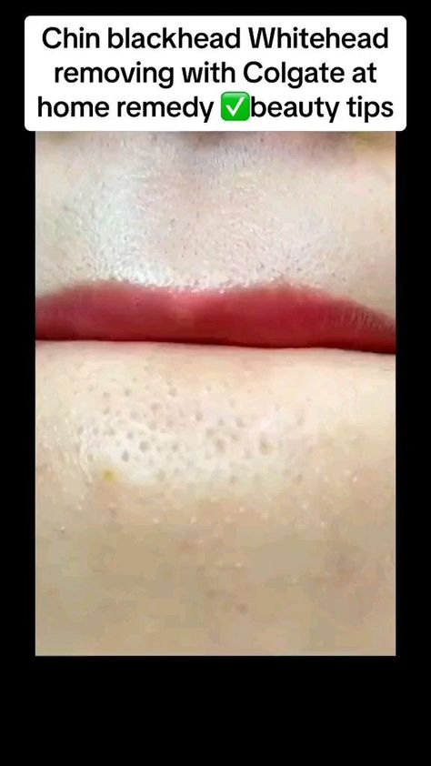 how to get rid of blackheads and Whiteheads ✨💋 Blackheads And Whiteheads, Face Skin Care Routine, Clear Healthy Skin, Rid Of Blackheads, Diy Skin Care Routine, Natural Face Skin Care, Good Skin Tips, How To Get Rid Of Pimples, Clear Skin Tips