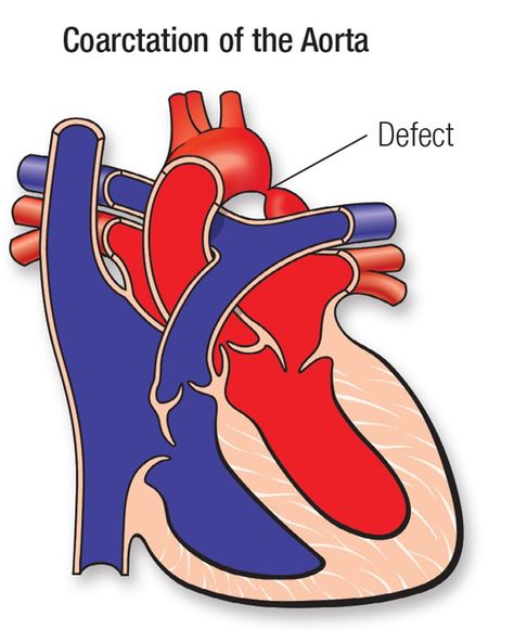 Aortic Valve Stenosis, Coarctation Of The Aorta, Patent Ductus Arteriosus, Cardiac Disease, Congenital Heart Defect, Heart Defect, Congenital Heart, Heart Function, Heart Muscle