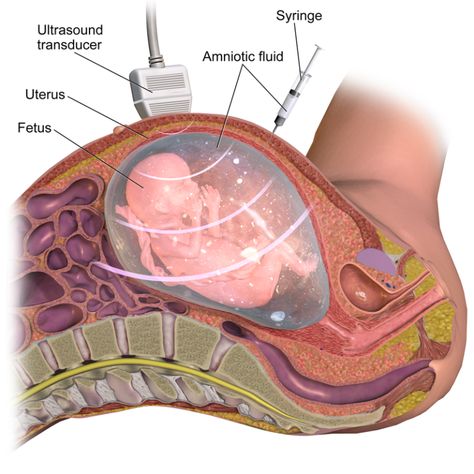 The key difference between amniocentesis and chorionic villus sampling is that in amniocentesis, a small amount of amniotic fluid is taken for testing while in chorionic villus sampling, a small sample of the placenta is taken for testing. Amniocentesis and Chorionic Villus Sampling are two prenatal diagnostic. Patau Syndrome, Fetal Heart Rate, Ultrasound Technician, Preterm Labor, Amniotic Fluid, Gestational Age, Not Your Baby, Genetic Disorders, Prenatal Care