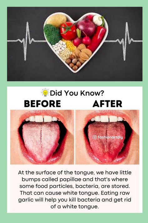 GET RID OF WHITE TONGUE #health #healthy diet #health tips #healthy foods #diet #diet tips #diet food #health benifits #remidies # white tongue # tongue # get rid of #garlic How To Get Rid Of White Tongue, Healthy Tongue, Eating Raw Garlic, White Tongue, Tips Diet, Raw Garlic, Tongue Health, Diet Food, Health Healthy