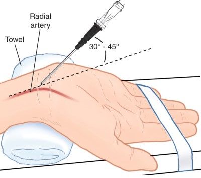 Arterial Line Placement: Basics for Medical Students EMRA Arterial System, Arterial Line, 12 Lead Ekg Placement Nursing Students, Coronary Angiography, Anesthesia School, Ekg Electrode Placement, Arterial Blood Gas, Students Day, Phlebotomy