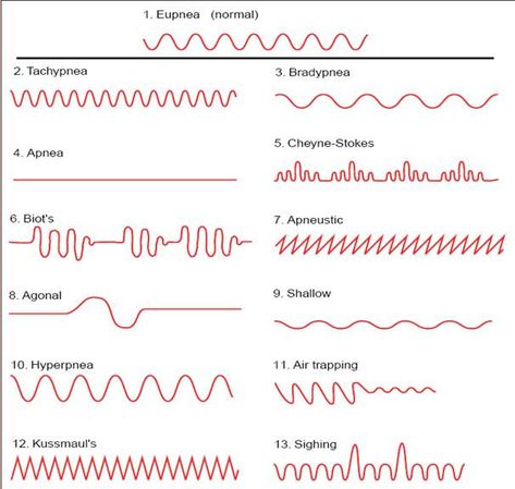 Biot's respiration and Cheyne Stokes Respiration. Respiratory Therapist Student, Respiratory Therapy Student, Breathing Patterns, Medical Terminology Study, Therapist Humor, Paramedic School, Cardiac Rhythms, Nursing Assessment, Nurse Study Notes