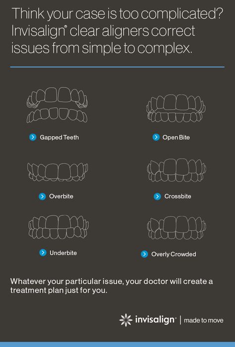 Overbite Before And After, Gapped Teeth, Smile Tips, Invisalign Aligners, Misaligned Teeth, Gap Teeth, Teeth Straightening, Clear Aligners, Study Organization