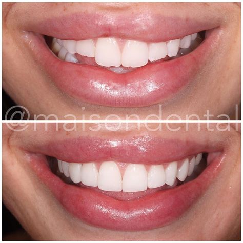 Maison Dental on Instagram: “One from the London clinic 💥 ⠀⠀⠀⠀⠀⠀⠀⠀⠀ This case was a combination of composite edge bonding on the front 6 teeth and composite veneers on…” Edge Bonding Teeth Before And After, Composite Edge Bonding Teeth, Composite Bonding Teeth Before And After, Edge Bonding Teeth, Composite Veneers Before And After, Teeth Bonding Before And After, Composite Bonding Teeth, Teeth Composite, Big Front Teeth