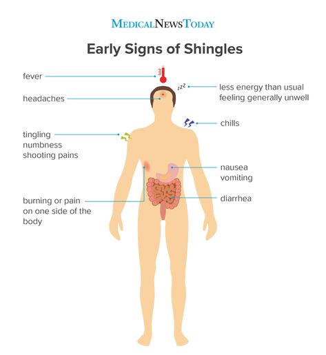 The early stages of shingles: Signs and symptoms Signs Of Shingles, Shingles Symptoms, Shingles Pain Relief, Shingles Remedies, Shingles Relief, Essential Oil Spray Recipes, Skin Symptoms, Brain Surgeon, Chronic Pain Relief