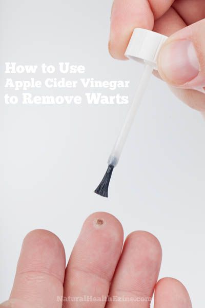 Did you know that you can bust a wart off in no time with Apple Cider Vinegar (or as it is affectionately known as ACV)? Organic Oregano Oil, Warts On Hands, Warts On Face, Remove Warts, Get Rid Of Warts, Oregano Oil, Natural Sleep Remedies, Natural Cold Remedies, Natural Cough Remedies