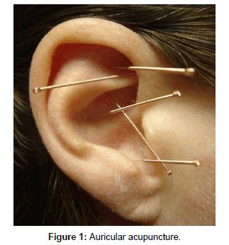 image Acupuncture Benefits, Vagus Nerve, Acupuncture Points, Acupressure Points, Good Mental Health, Chinese Medicine, Acupressure, Alternative Medicine, Acupuncture