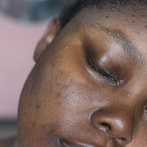 Learn how to help resolve hyperpigmentation on Black skin with a solid skin care routine. Dark Marks On Face, Hyperpigmentation Black Skin, Increase Melanin, Skin Care Pictures, Inflammation Causes, Broad Spectrum Sunscreen, Even Skin Tone, Skin Conditions, Face Cleanser