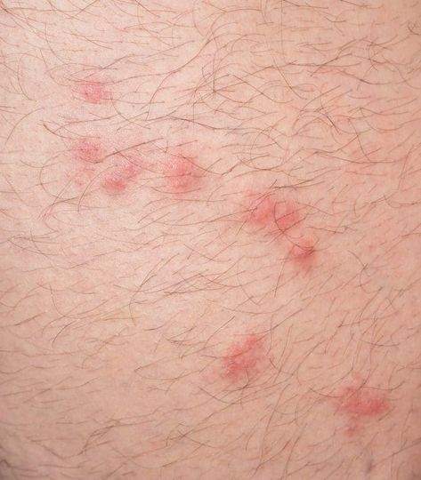 This is what a Flea Bite looks like Spider Bite Symptoms, Flea Bomb, Sand Fleas, Ant Bites, Rid Of Bed Bugs, Flea Infestation, Bed Bug Bites, Cedar Oil, Spider Bites