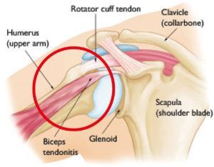 Bicep Tendonitis Bicep Tendon, Shoulder Rehab Exercises, Biceps Muscle, Shoulder Rehab, Shoulder Problem, Shoulder Impingement, Bicep Muscle, Shoulder Pain Relief, Shoulder Injuries