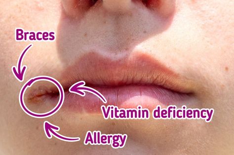 Perhaps many of us have faced a situation when painful cracks and inflammation appeared in the corners of our lips. It seems it happens without any reason — they just appear at some moment and then disappear after some time, having caused a bit of discomfort. 5-Minute Crafts collected information about this phenomenon and is going to tell you about the reasons for its appearance and the methods to prevent it. Cracks On The Side Of Mouth, Dry Lips Causes, Cracks In Corner Of Mouth, Cracked Lip Corners, Cracked Corners Of Mouth, Lips Cracked, Dry Cracked Lips, Cracked Lips, What To Use