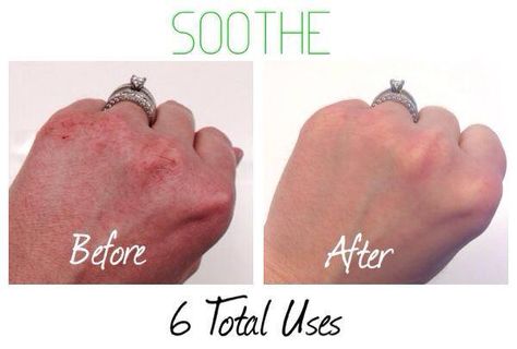 Is the cold winter taking its toll on your hands? R+F can help. Rodan And Fields Soothe, Rodan Fields Skin Care, Chapped Hands, Dry Skin Patches, Clear Skin Tips, Coconut Oil For Skin, Cracked Skin, Love Your Skin, Happy Skin