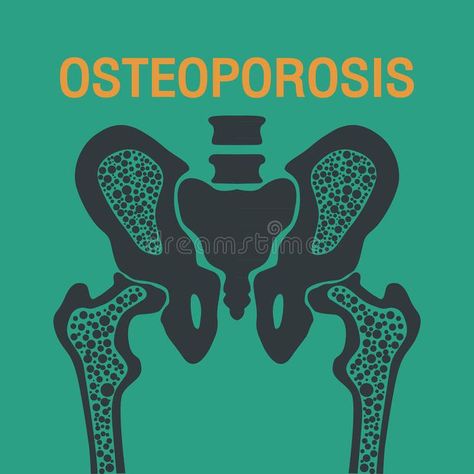 OSTEOPOROSIS vector logo royalty free illustration Poster Design Png, World Osteoporosis Day, Logo Icon Design, Blue Abstract Art, Free Illustration, Logo Icon, Art Blue, Design Png, Free Illustrations