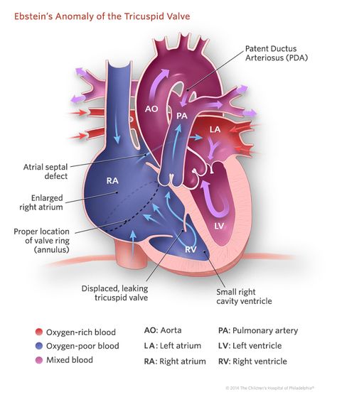 Ebstein’s Anomaly of the Tricuspid Valve Illustration Cath Lab Nursing, Cardiac Sonography, Atrial Septal Defect, Cardiology Nursing, Heart Structure, Tricuspid Valve, Diagnostic Medical Sonography, Medical School Life, Congenital Heart Defect