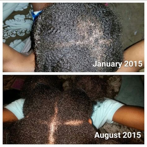 How I Made A Come Back The Right Way And Reversed My Severe Crown Breakage  Read the article here - http://www.blackhairinformation.com/growth/hair-problems/made-come-back-right-way-reversed-severe-crown-breakage/ Hair Thinning At Crown, Hair Breakage Remedies, Stop Hair Breakage, Hair Advice, Healthy Hair Tips, Hair Affair, Black Hair Care, Hair Remedies, Natural Hair Tips