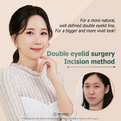 Make your eyes look bigger and more vivid with Grand`s incisional Double Eyelid Surgery! This method perfectly suits those, who have thicker skin, sagging skin as well as excessive fat on the eyelids. Find out all about Grand’s double eyelid surgery in this posting!  For online consultation🎀 Tel: (+82) 70-7119-1580 Mobile: (+82) 10-9132-6546 (Whatsapp, Line, Kakaotalk, Viber, iMessage) Email: grandps.en@gmail.com Facebook: Grand Plastic Surgery, Korea Website: eng.grandsurgery.com Pinterest : h Plastic Surgery Korea, Make Your Eyes Look Bigger, Eyes Look Bigger, Online Consultation, Double Eyelid, Thick Skin, After Surgery, Sagging Skin, Plastic Surgery