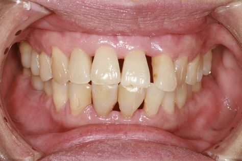 Home Remedies for Periodontal Disease | Livestrong.com Family Dental Care, Bad Teeth, Emergency Dentist, Pediatric Dentist, Periodontal Disease, Dental Problems, Tooth Decay, Oral Hygiene, Dental Health