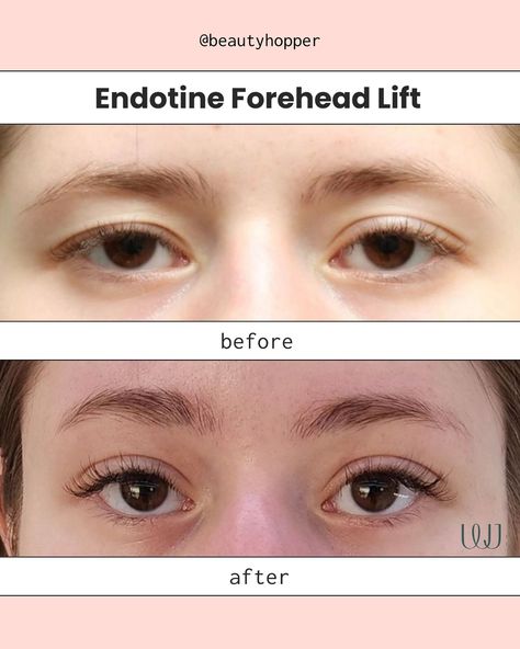 🙋‍♀️Raise your hand if sagging eyelids & deep forehead wrinkles are making you look older than you feel! Endotine Forehead Lift could be your solution for a smoother, more rejuvenated look. Good Candidates for Endotine Forehead Lift Surgery 🤫 ✅ If you have Sagging Eyebrows ✅ If you have sagging eyelids ✅ If you have deep forehead wrinkles ✅ If you have noticeable frown lines For pricing inquiries please contact us below:  💌: contact@beautyhopper.com 📲: WhatsApp: +(82)1098587703 With @be... Eyebrow Lift Surgery, Deep Forehead Wrinkles, Sagging Eyelids, Forehead Lift, Frown Lines, Eyebrow Lift, Eyelid Lift, Forehead Wrinkles, Raise Your Hand If