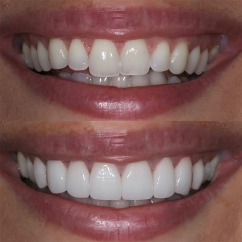 Teeth Makeover, Bathroom Porcelain, Grow Back Receding Gums, Whiten Teeth Fast, Porcelain Tile Floor, I Healed, Pretty Teeth, Porcelain Wood Tile, Veneers Teeth