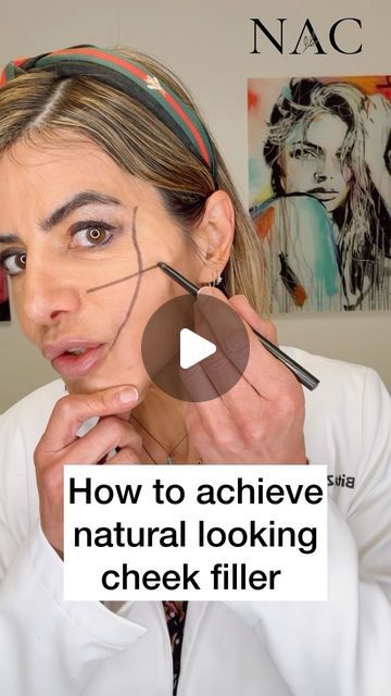 Dr. Bita Zadeh Farrell on Instagram: "Filler placement is an art.   #cheekfiller #drbitafarrell #naturalaestheticscenter" Medial Cheek Filler, Mid Cheek Filler, Cheek Filler Injection Sites, Cheek Filler Placement, Midface Cheek Filler, Filler Injection Sites, Mid Face Filler, Botox Face Lift, Cheekbone Filler Before And After