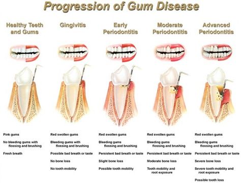 Dentaltown - Progression Of Gum Disease Surgery Humor, Dental Assistant Study, Remedies For Tooth Ache, Dental Cavities, Dental Facts, Dental Design, Dental Bridge, Periodontal Disease, Dental Surgery