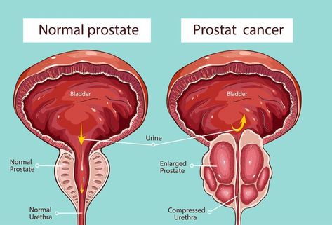 prostatitis Male Libido, Libido Boost For Men, Prostate Surgery, Libido Boost, Power Of Knowledge, Surgery Doctor, Disease Symptoms, Types Of Cancers, Spiritual Health