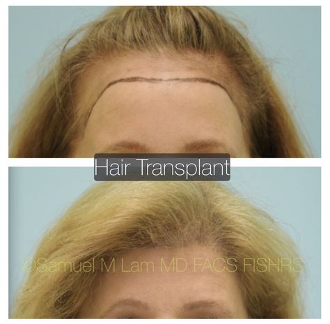 WOMAN’S WEDNESDAY: This 62-year-old woman had a 10-year history of hair loss and is shown before and after hair transplant to restore her lost hairline, hair density, and temples. If you need a consult with Dr. Lam please contact by ⠀ 📞972-312-8105 ⠀ Hairline Transplant, Hair Transplant Women, Before And After Hair, Plano Texas, Female Hair, Speak English, Growth Oil, Hair Density, Hair Transplant