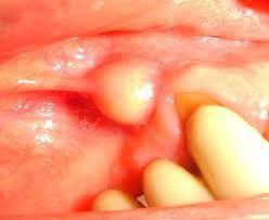 Abscess Drainage, Dental Abscess, Abscess Tooth, Survival Medicine, Dental Infection, Teeth Remedies, Gum Surgery, Tooth Infection, Gum Inflammation