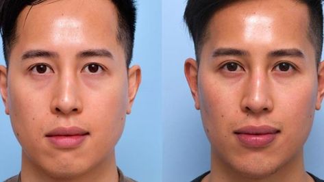 Face Shape Before And After Wisdom Teeth Removal? Recipes For After Wisdom Teeth Removal, Foods For After Wisdom Teeth Removal, Teeth Reshaping Before And After, Things To Eat After Wisdom Teeth Removal, Wisdom Tooth Removal, Wisdom Teeth Recovery, After Wisdom Teeth Removal, Wisdom Tooth Extraction, Tooth Removal