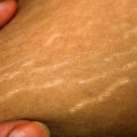 The post Stretch marks: Why they appear and how to get rid of them appeared first on Healthy, Happy and Confident Lifestyle. One thing about stretch marks – they do not discriminate. Stretch marks will appear on the skin of men and women regardless of how well you eat, your activity levels, or your skin care regimen. In today’s age of the ‘self-love’ movement, many are fighting to accept all of the little imperfections they get, and... The post Stretch marks: Why they appear and how to get Stretch Mark Removal Cream, Happy And Confident, Stretch Mark Remedies, Work Grind, Marks Cream, Wellness Mama, Stretch Mark Cream, Stretch Mark Removal, No Money