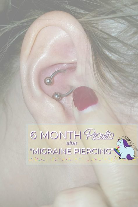 6 Months of results after daith piercing for migraines. Daith Piercing For Migraines, Piercing For Migraines, Daith Piercing Migraine, Migraine Piercing, Daith Ear Piercing, Migraine Awareness, Headache Relief Instant, Daith Rings, Types Of Ear Piercings