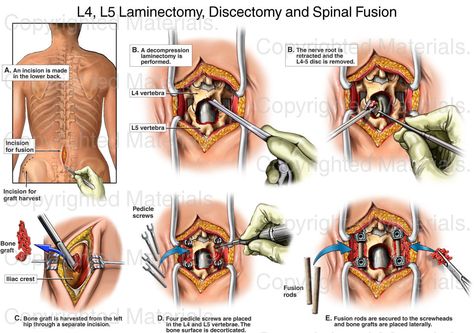 Back Surgery - L4, L5 Lumbar Laminectomy, L4-5 Discectomy (Diskectomy) and Spinal Fusion with Pedicle Screws and Rods. Laminectomy Recovery, Laminectomy Surgery, Microdiscectomy Recovery, Surg Tech, Pain Chart, Spinal Fusion Surgery, Cauda Equina, Medical Projects, Spinal Fusion