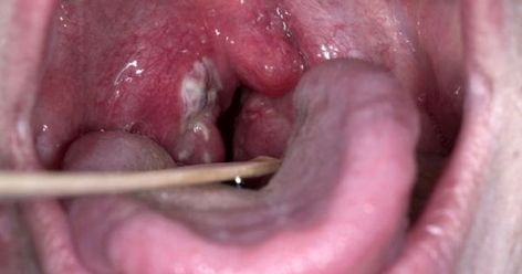 Symptoms of Streptococcal Bacterial Infections Strep Throat Symptoms, Lymph Glands, Saline Nasal Spray, Throat Remedies, Throat Pain, Throat Infection, Strep Throat, Healthy Substitutions, Bacterial Infection